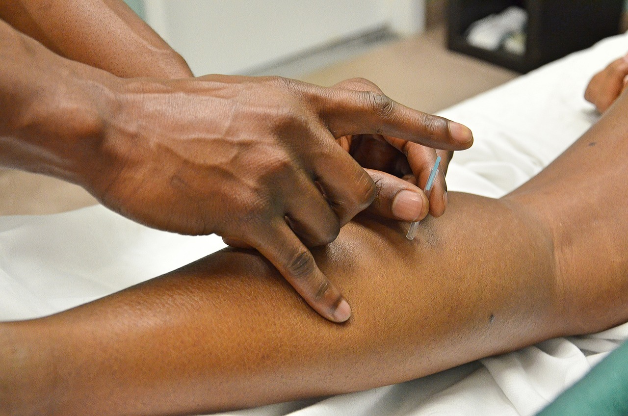 Acupuncture treatment at ABC Wellness Gainesville FL